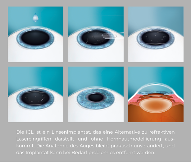 Die ICL ist ein Linsenimplantat, das eine Alternative zu refraktiven Lasereingriffen darstellt und ohne Hornhautmodellierung auskommt. Die Anatomie des Auges bleibt praktisch unverändert, und das Implantat kann bei Bedarf problemlos entfernt werden.