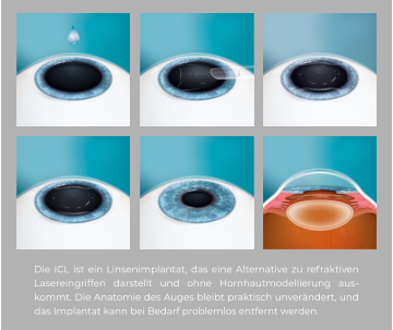 Die ICL ist ein Linsenimplantat, das eine Alternative zu refraktiven Lasereingriffen darstellt und ohne Hornhautmodellierung auskommt. Die Anatomie des Auges bleibt praktisch unverändert, und das Implantat kann bei Bedarf problemlos entfernt werden.