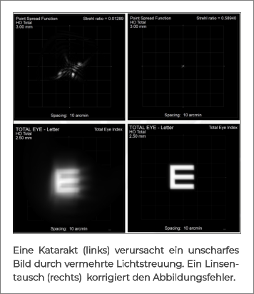 Eine Katarakt (links) verursacht ein unscharfes Bild durch vermehrte Lichtstreuung. Ein Linsentausch (rechts)  korrigiert den Abbildungsfehler.
